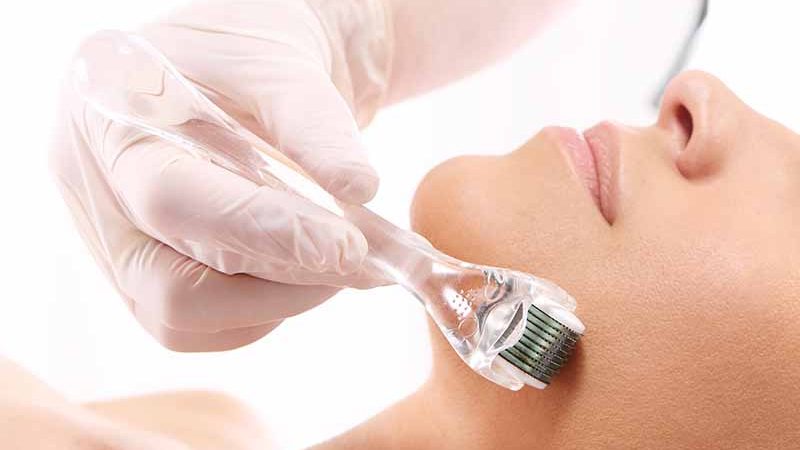 Microneedling Anwendung mit einem Dermaroller