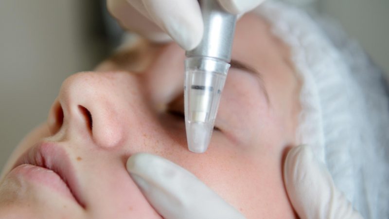 Woman Microdermabrasion